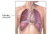 tràn dịch màng phổi