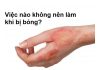 Lưu ngay những việc nào không nên làm khi bị bỏng?