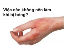 Lưu ngay những việc nào không nên làm khi bị bỏng?