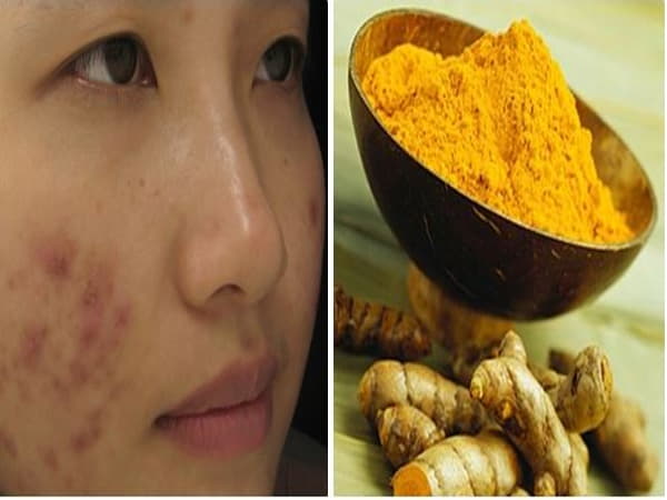 Củ nghệ có trị thâm không