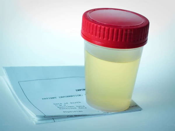 Cách cải thiện màu nước tiểu và ngăn ngừa sỏi thận